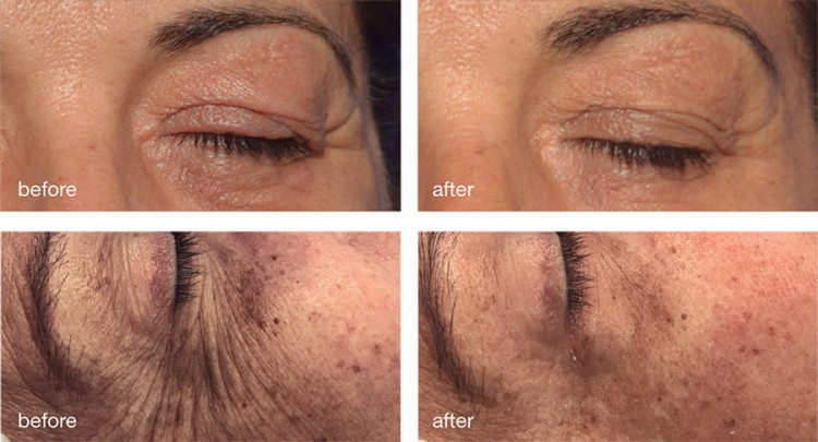 Mesoestetic-Global-Eyecon.jpg